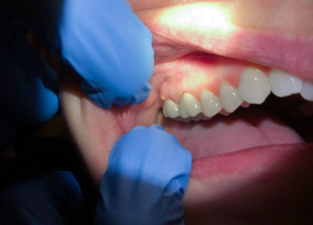 Best Emergency Dentist for Lost Fillings or Crowns in Vincent, AL